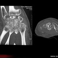 ostéonécrose post-traumatique du lunatum : TDM